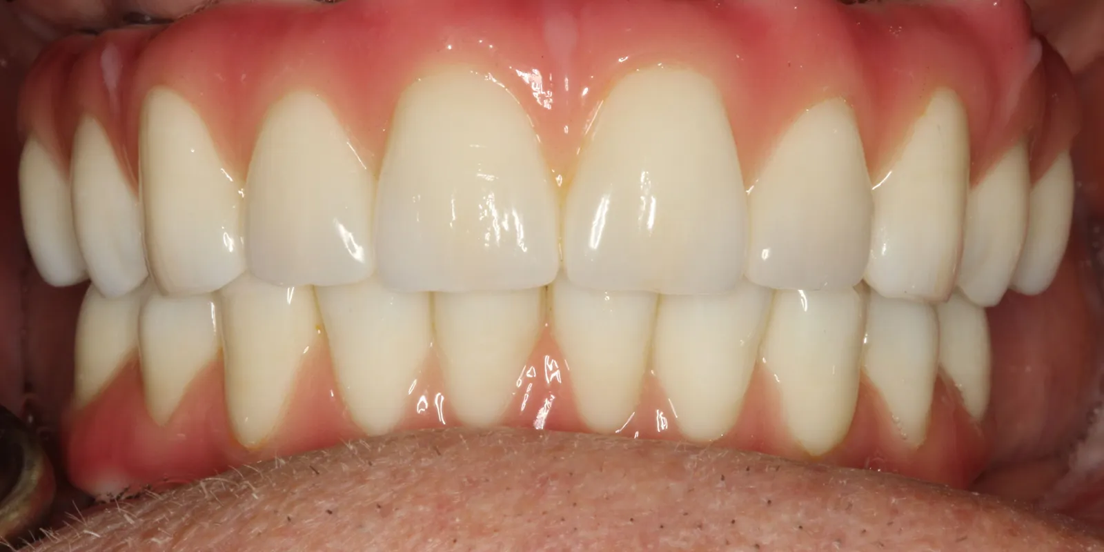All on X Treatment