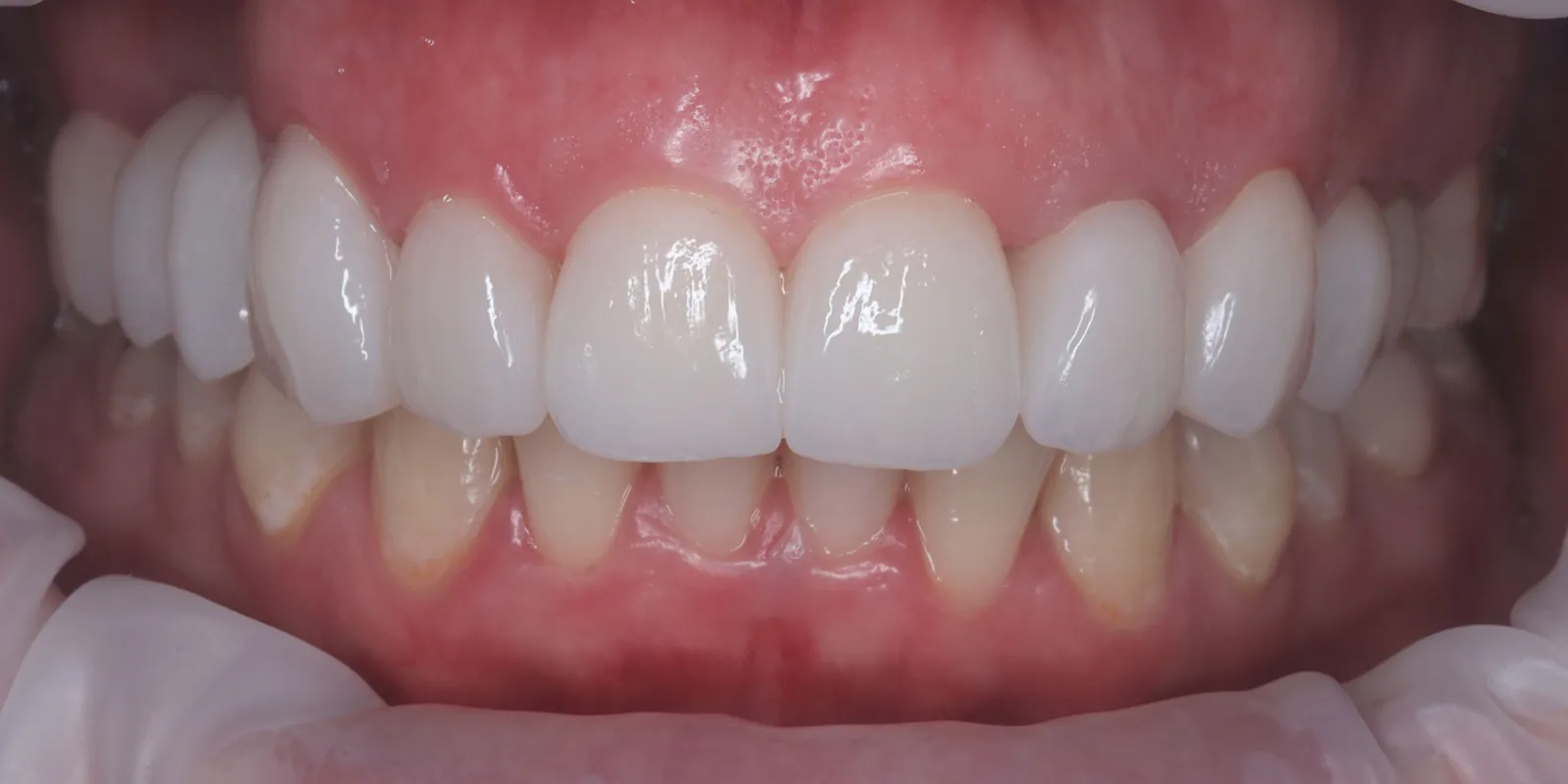 Smile Makeover