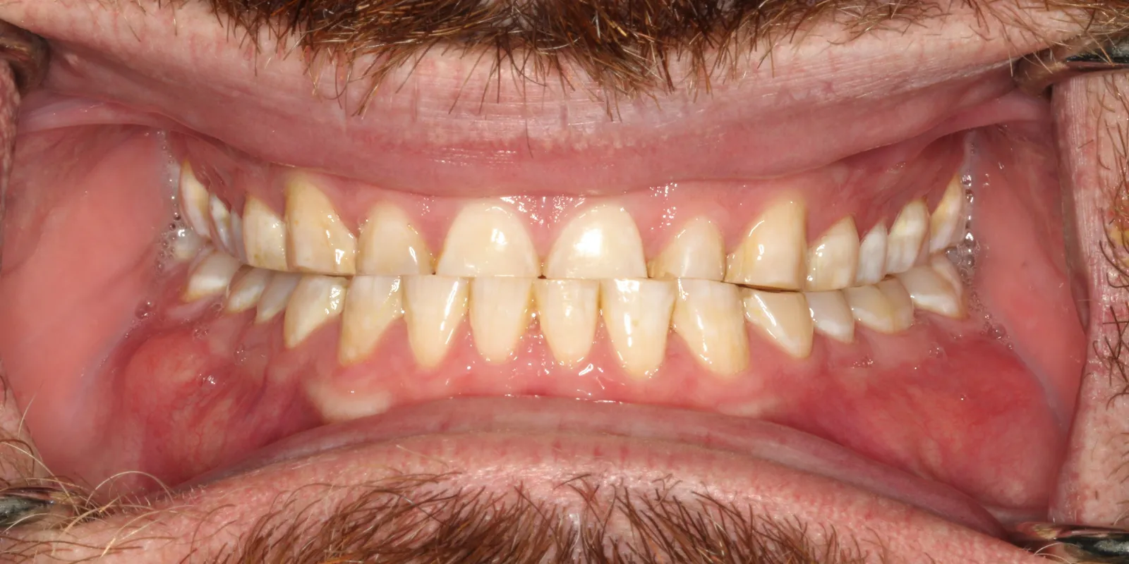 Smile Makeover
