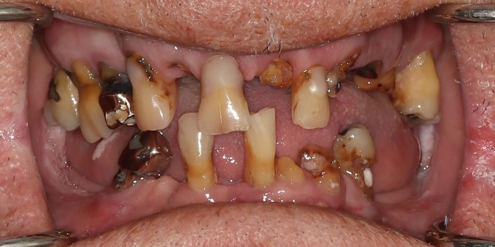 All on X treatment 