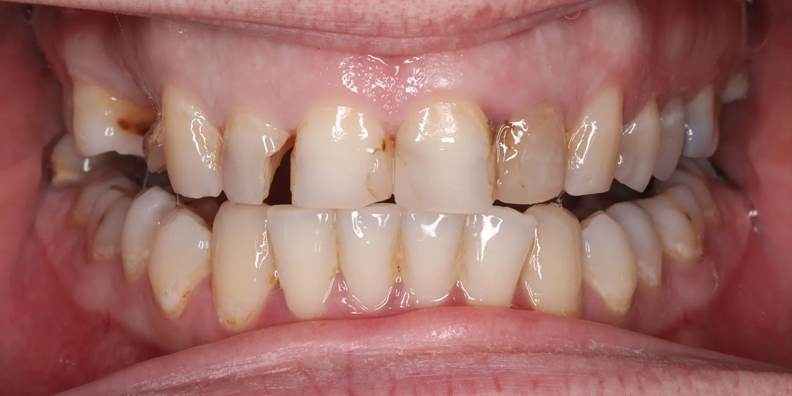 Smile Makeover