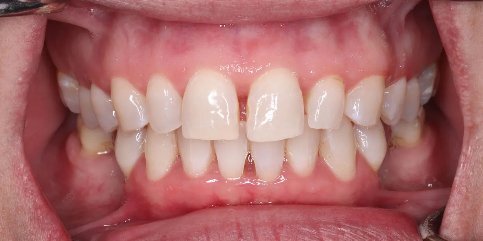Smile Makeover