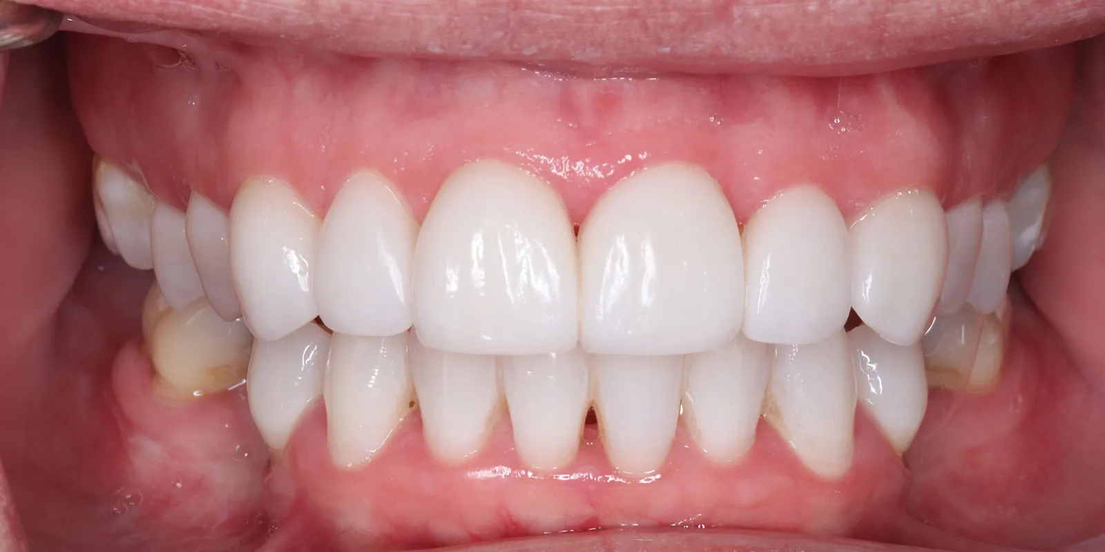 Smile Makeover