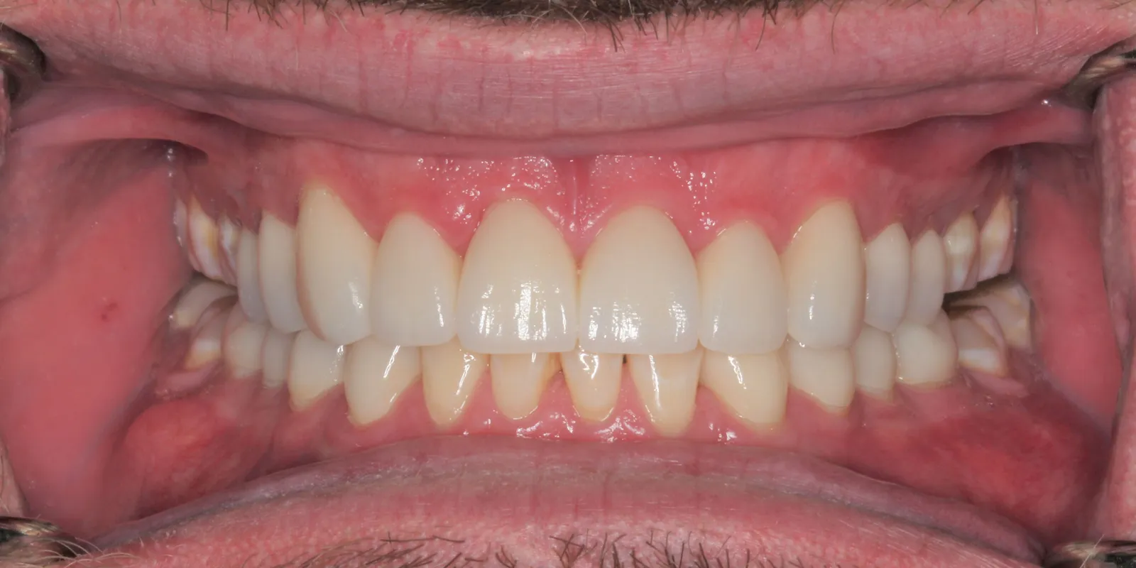 Smile Makeover
