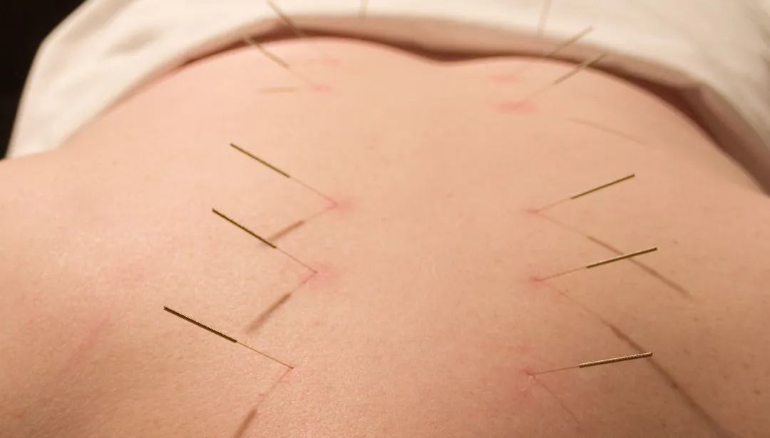 Dry Needling or Acupuncture. Which one will work for my condition?