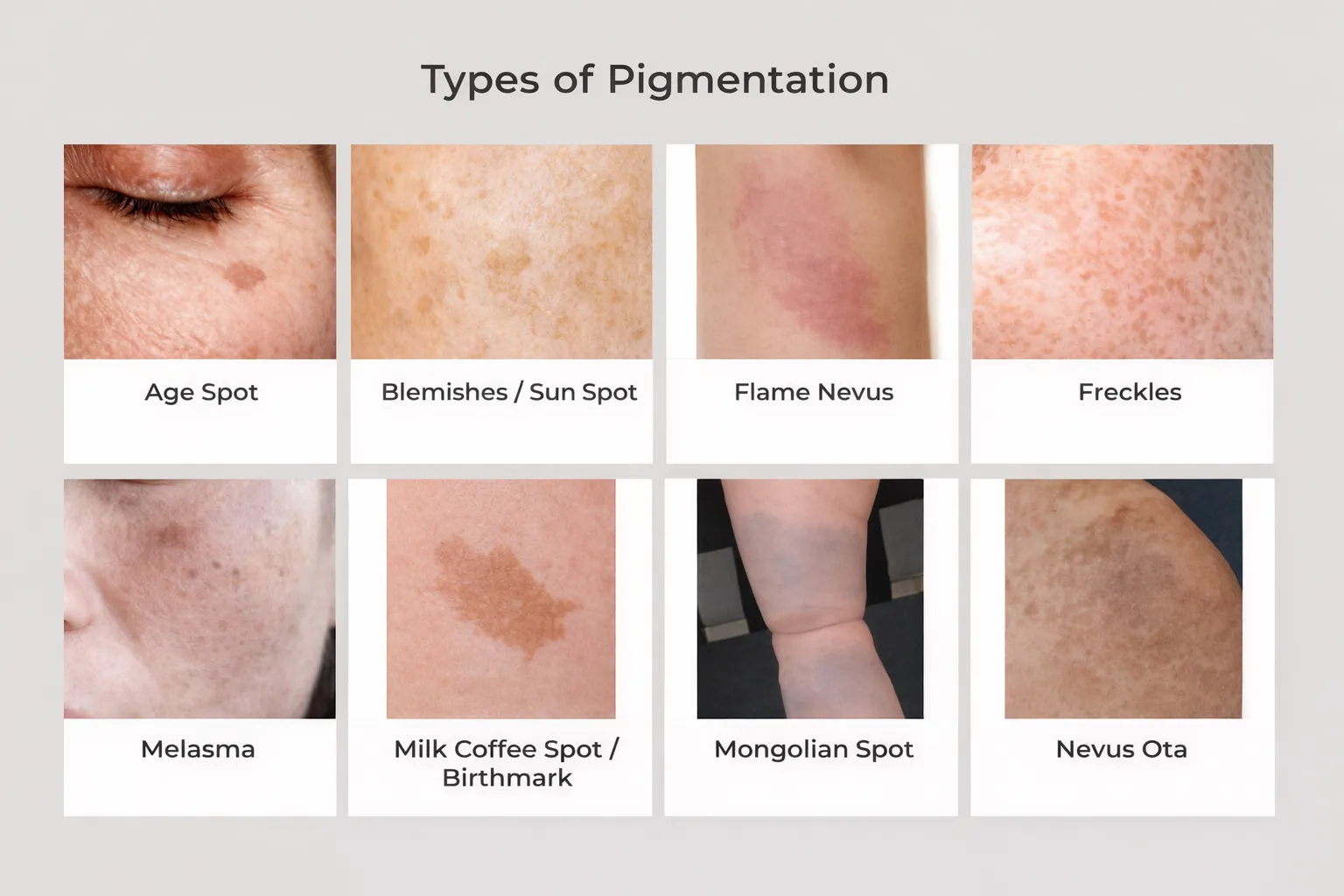 8 Different types of skin pigmentation